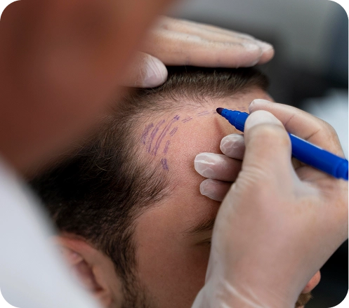 خدمة زراعة الشعر