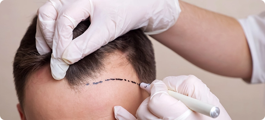 زراعة الشعر استعد ثقتك بمظهر طبيعي